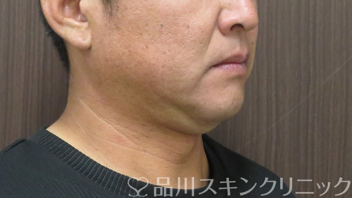 症例NO.72371のBEFORE写真