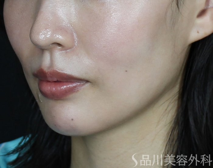 症例NO.70119のBEFORE写真