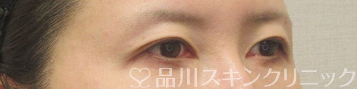 症例NO.71138のBEFORE写真