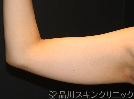 症例NO.70215のBEFORE写真