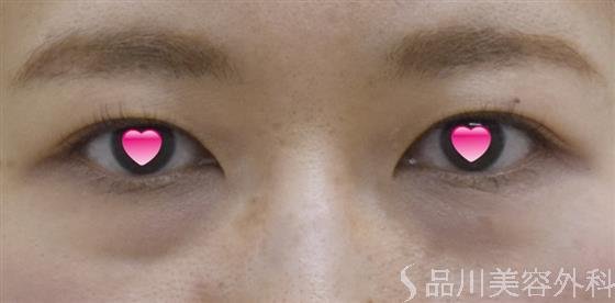 症例NO.52437のBEFORE写真