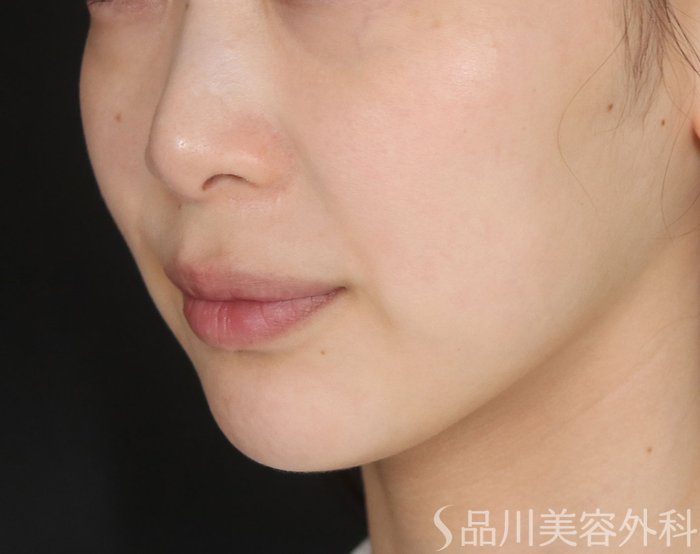 症例NO.73706のBEFORE写真