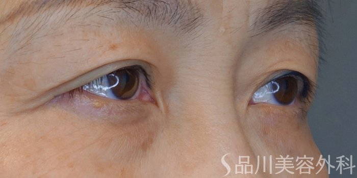 症例NO.68199のBEFORE写真