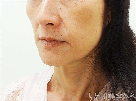 症例NO.30517のBEFORE写真