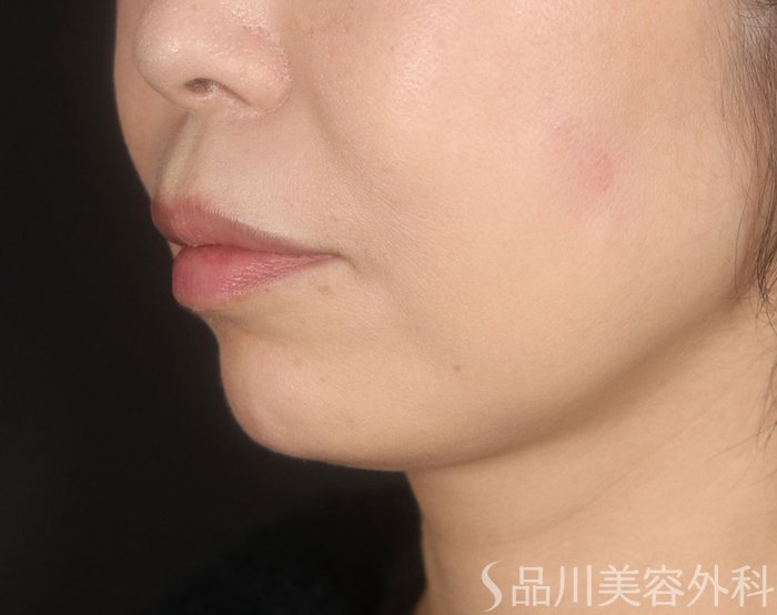 症例NO.73077のAFTER写真