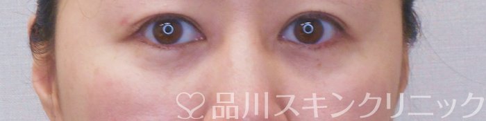 症例NO.71412のAFTER写真