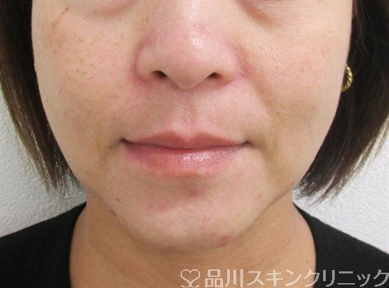 症例NO.49710のAFTER写真