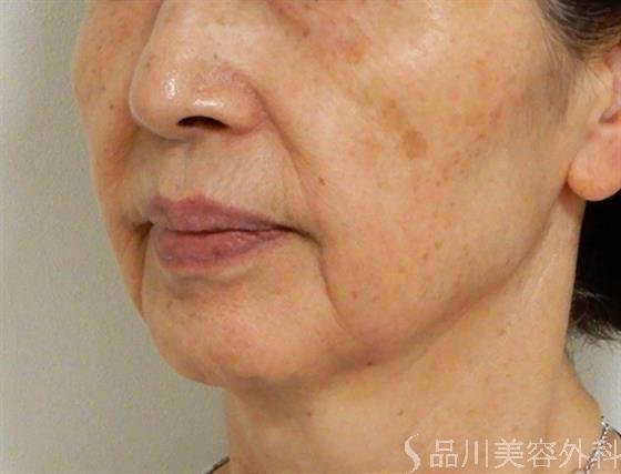 症例NO.39897のBEFORE写真