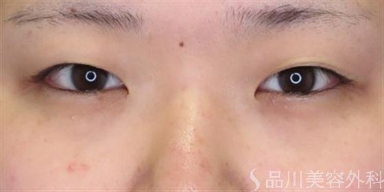 症例NO.48196のBEFORE写真