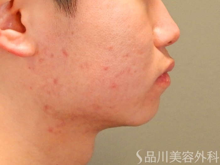 症例NO.69691のBEFORE写真