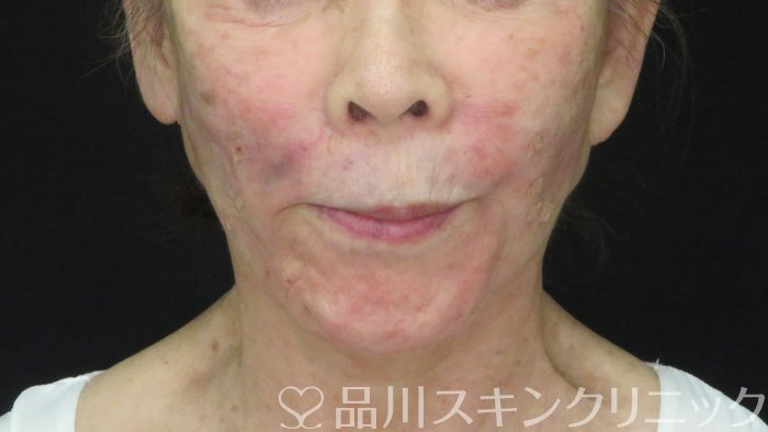 症例NO.72288のAFTER写真