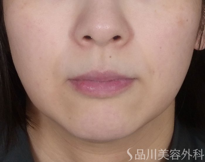 症例NO.67698のBEFORE写真