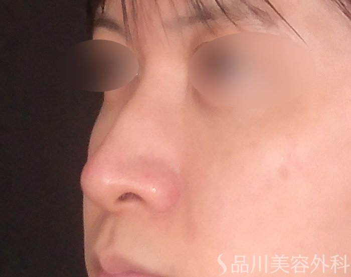 症例NO.70649のAFTER写真