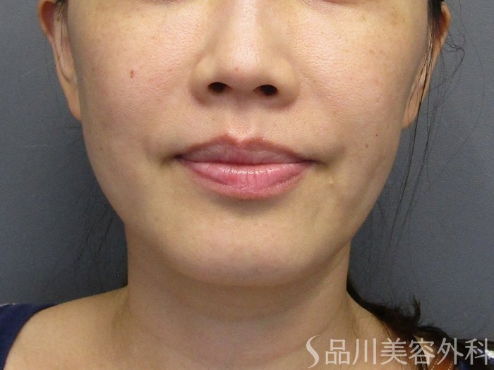 症例NO.75231のBEFORE写真