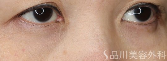 症例NO.73244のBEFORE写真