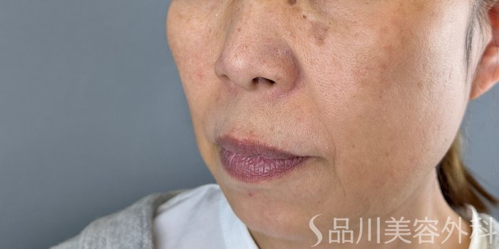 症例NO.72412のBEFORE写真