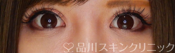 症例NO.64888のAFTER写真