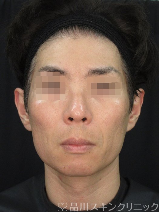 症例NO.72208のAFTER写真