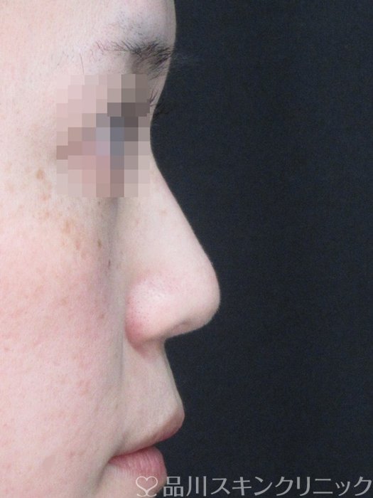 症例NO.73121のBEFORE写真