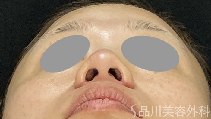症例NO.74380のAFTER写真