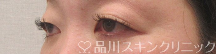 症例NO.73753のBEFORE写真