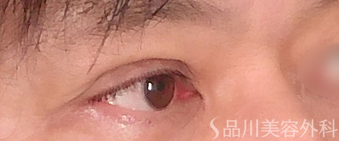 症例NO.69360のAFTER写真