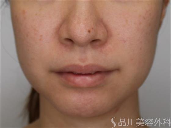 症例NO.49880のBEFORE写真