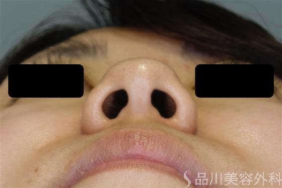 症例NO.50383のBEFORE写真