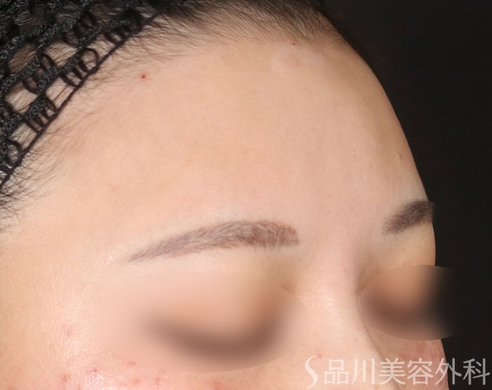 症例NO.73406のAFTER写真