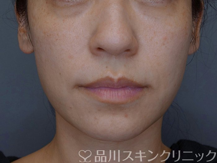 症例NO.74961のBEFORE写真