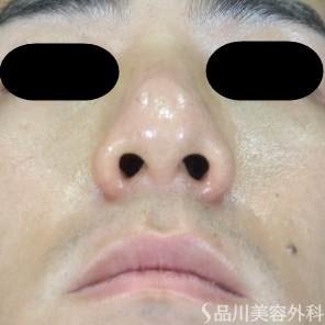 症例NO.72946のBEFORE写真