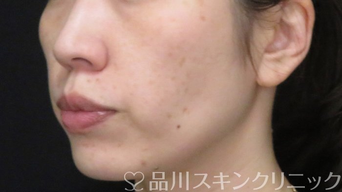症例NO.70866のBEFORE写真
