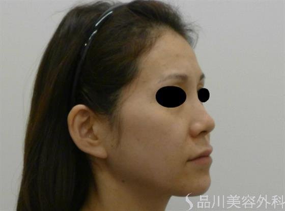 症例NO.43756のBEFORE写真