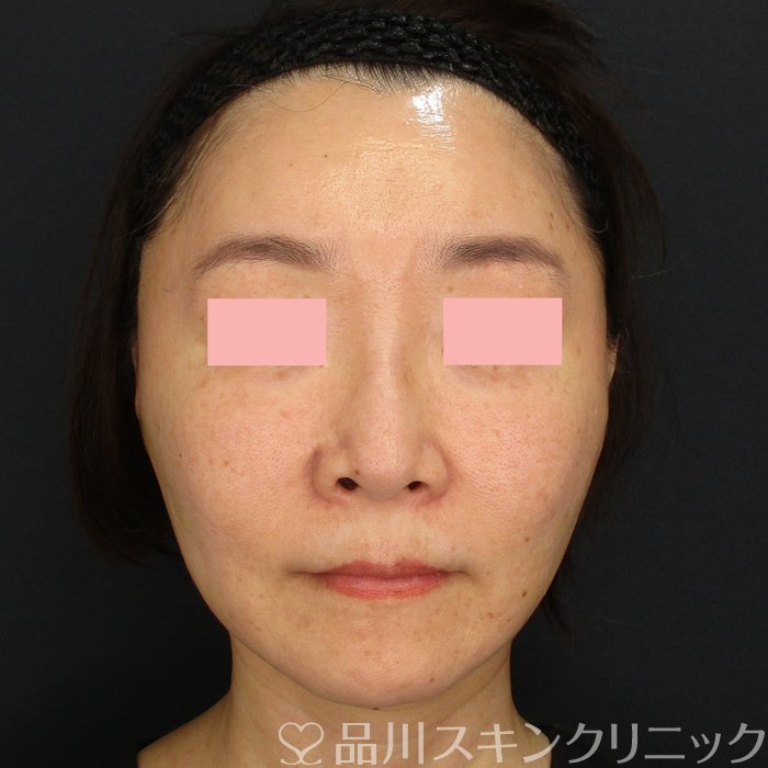 症例NO.71742のAFTER写真