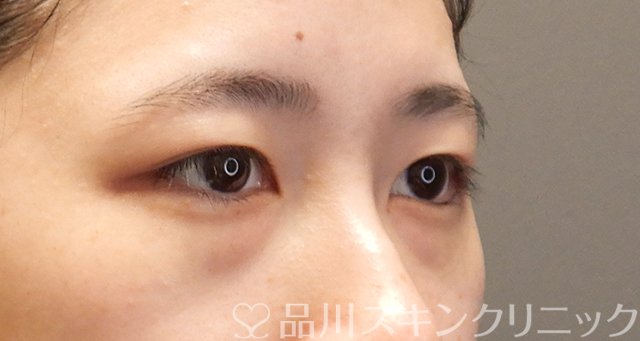 症例NO.75057のBEFORE写真