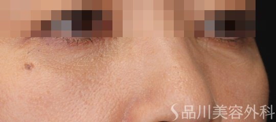 症例NO.62297のAFTER写真