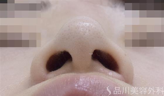 症例NO.50388のAFTER写真