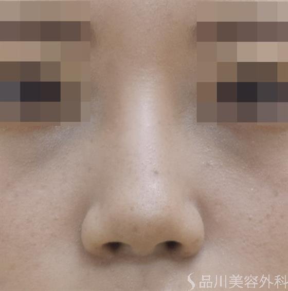 症例NO.45651のBEFORE写真