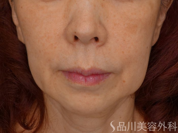 症例NO.73758のBEFORE写真