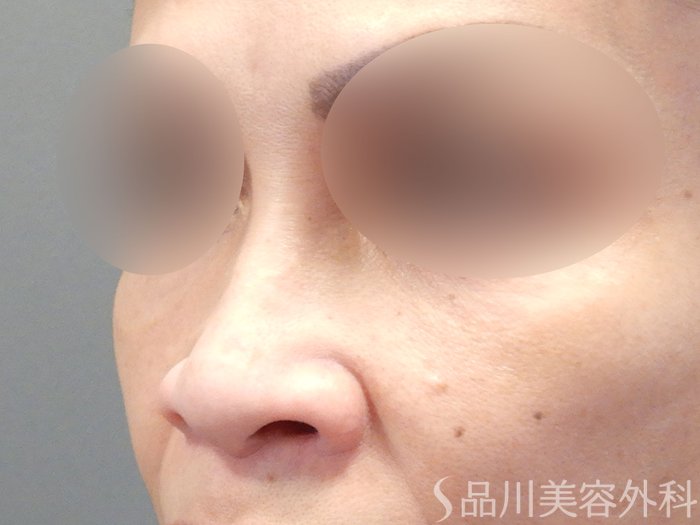 症例NO.74188のBEFORE写真