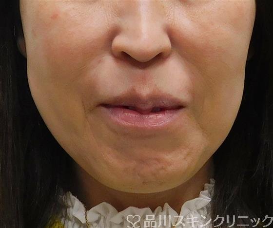 症例NO.54169のBEFORE写真