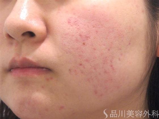 症例NO.23264のBEFORE写真