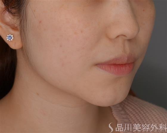 症例NO.51167のBEFORE写真