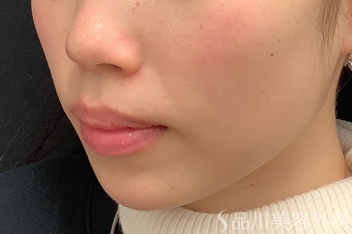 症例NO.69642のBEFORE写真