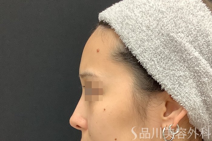 症例NO.67784のBEFORE写真
