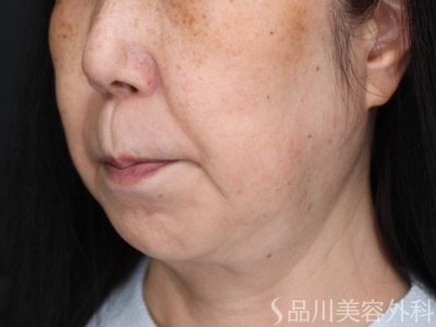 症例NO.71793のBEFORE写真