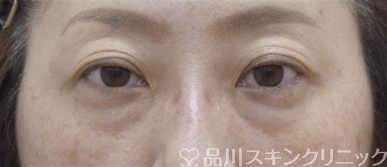 症例NO.53599のBEFORE写真