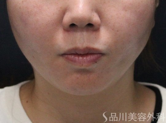 症例NO.75104のAFTER写真