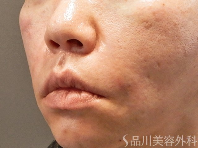 症例NO.69213のAFTER写真