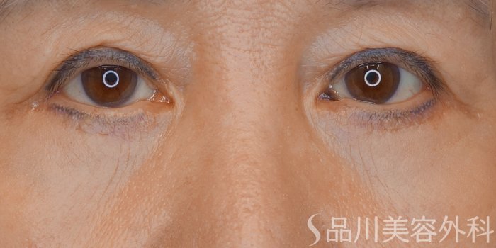 症例NO.70995のAFTER写真